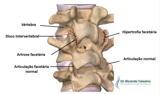 Ilustração anatômica de vértebras lombares com disco intervertebral, articulação normal, artrose facetária e hipertrofia facetária.