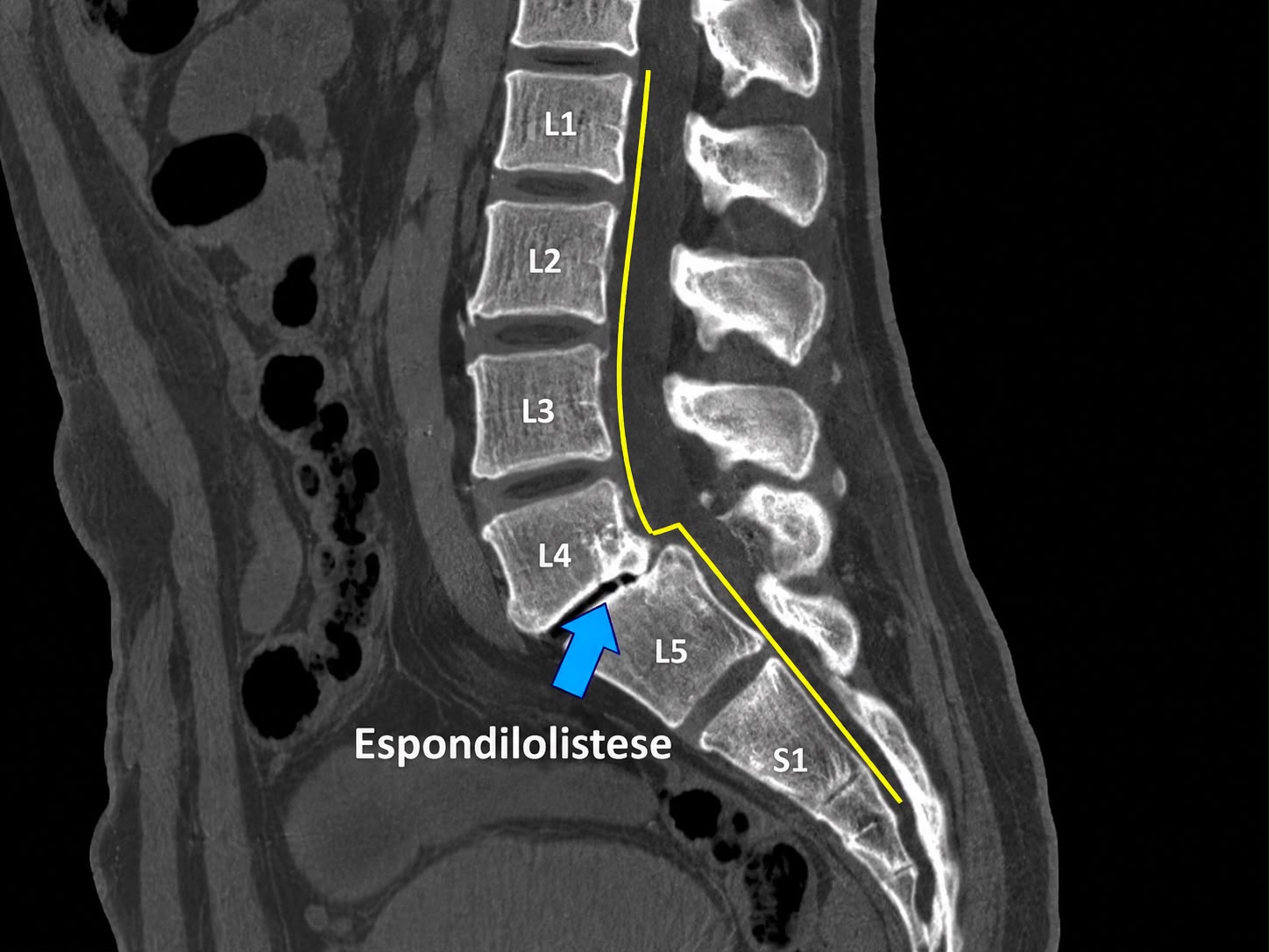Imagem sagital da coluna lombar com marcação de espondilolistese e níveis L1 a S1.