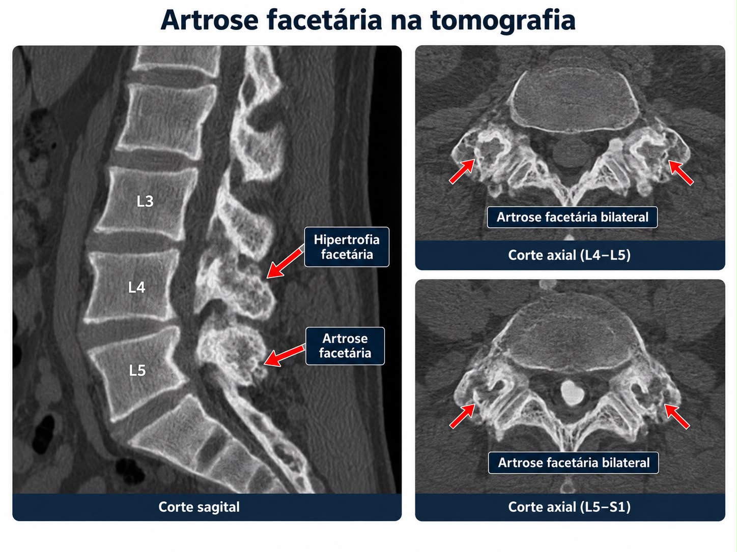 Tomografia lombar demonstrando hipertrofia e artrose facetária em cortes sagital e axial.